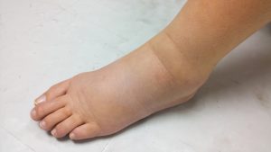 Lymphedema-foot